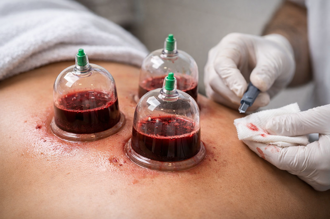 Hijama: The Prophetic Healer