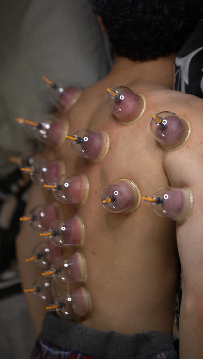 Hijama Sunnah Cupping Set (12 Cups) – Reusable Cupping Kit